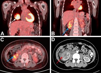 Case Report: 18F-FDG PET/CT and Laparoscopic Nephron Sparing Surgery in the Management of Bleeding From Renal Metastases of Choriocarcinoma